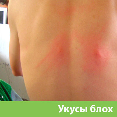Укусы блох в Липецке