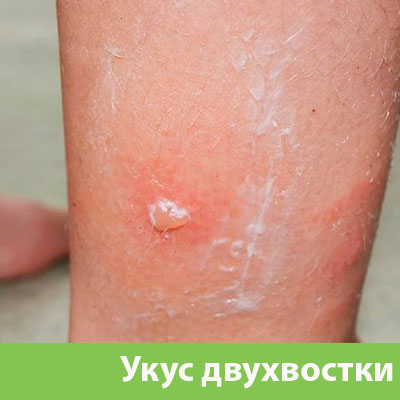 Укус двухвостки в Липецке