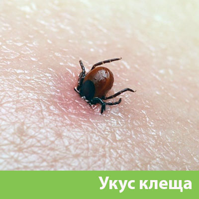 Укус клеща в Липецке