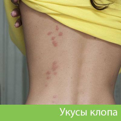 Профессиональное уничтожение клопов в Липецке